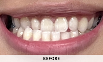 Invisalign gallery