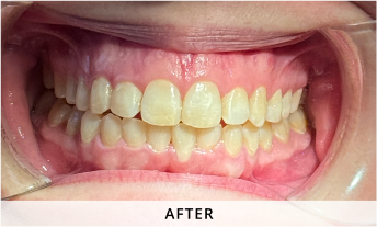 Invisalign gallery