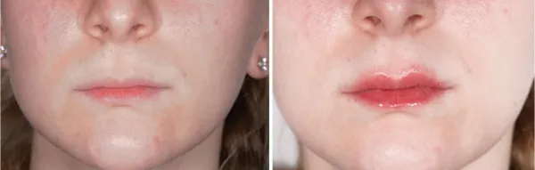 A mouth before and after a laser facial