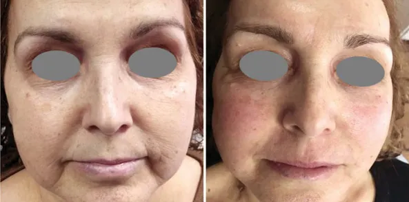 A face before and after a laser facial