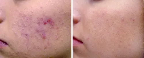 A check before and after a laser facial