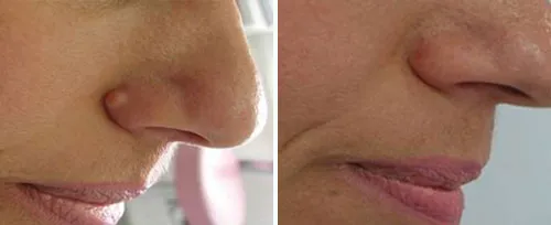 The side of a nose before and after a laser facial