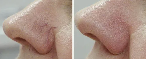 A nose before and after a laser facial